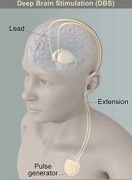 DBS system components diagram